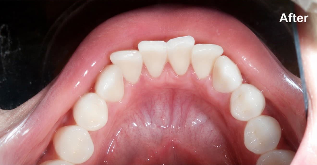 After full arch restoration at M&M Dental and Medical Polyclinic