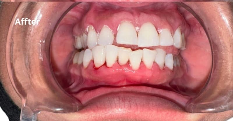 After smile makeover at M&M Dental and Medical Polyclinic