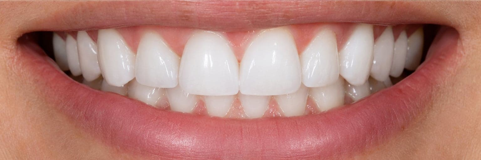 After smile transformation at M&M Dental and Medical Polyclinic